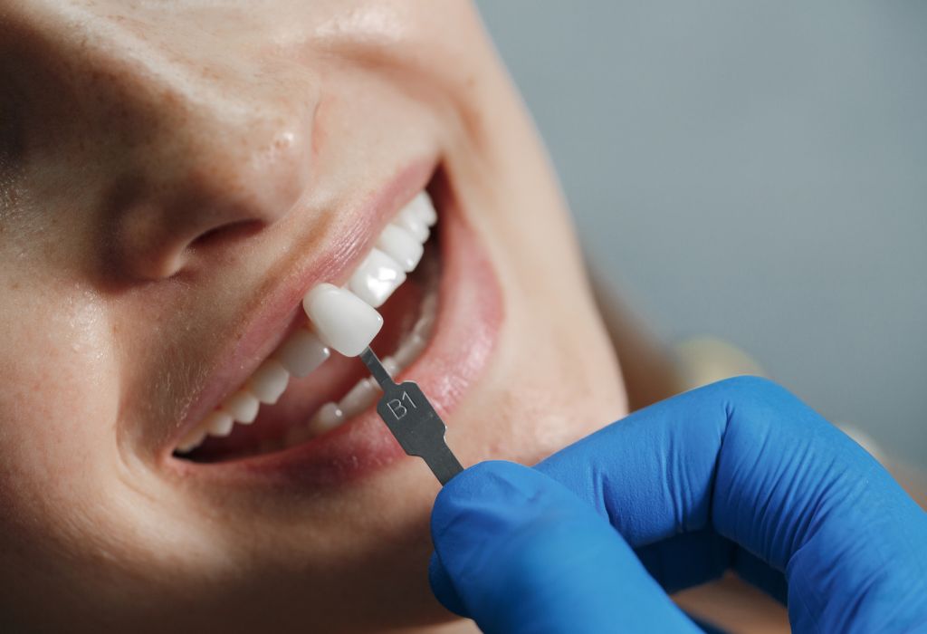 Qué tipo de carillas dentales son mejores