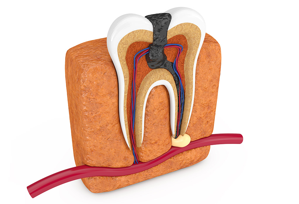 caries solucionada con endodoncia