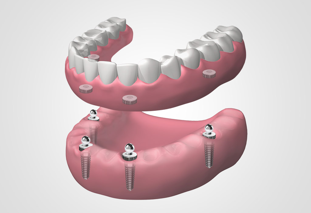 dentadura completa extraíble