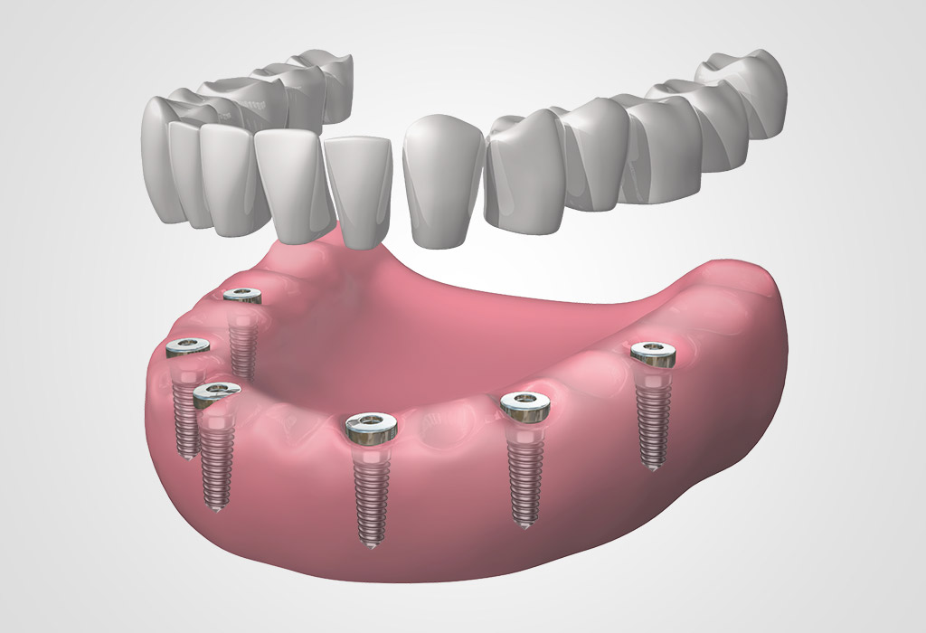 dentadura completa fija