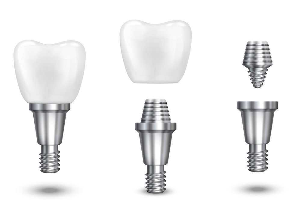 implantes dentales en hospitalet de llobregat