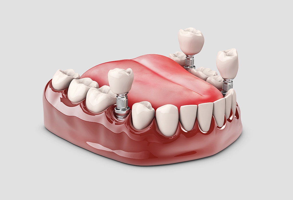 protesis dentales sobre implantes dentales