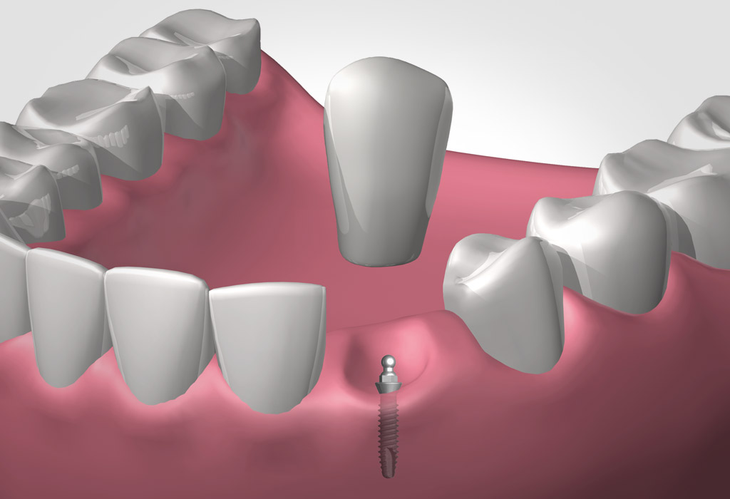 mini-implantes dentales