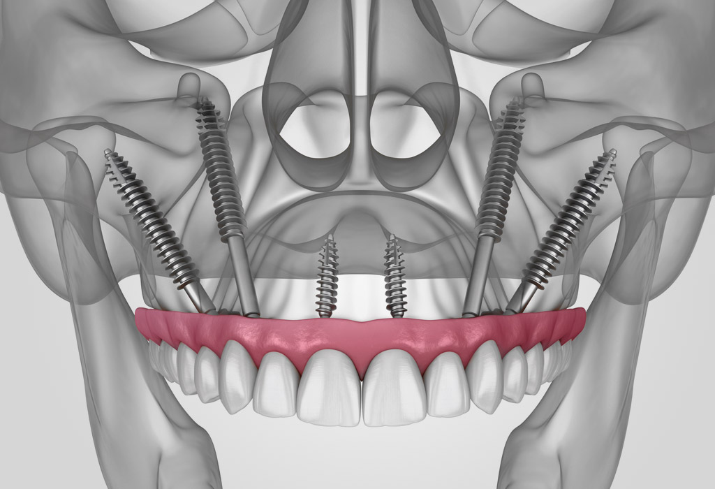 implantes dentales zigomáticos