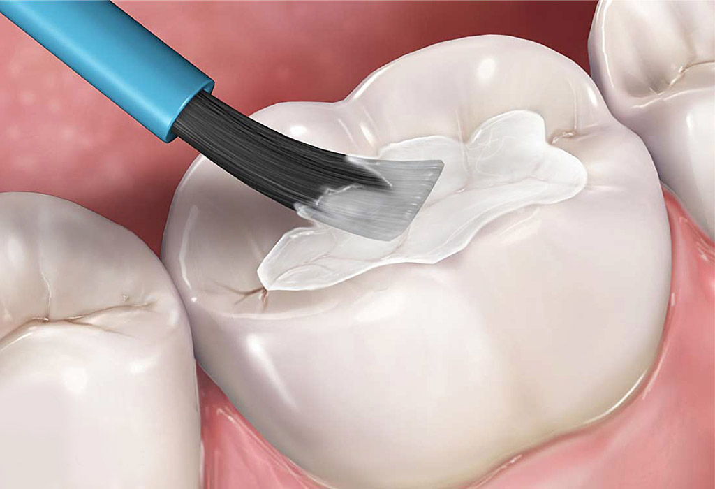 tratamientos contra la caries