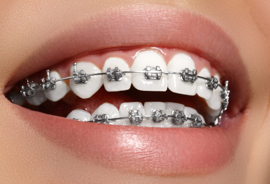 ortodoncia convencional