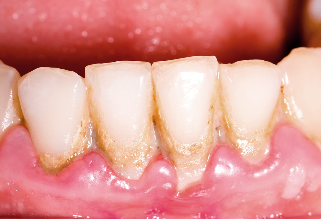 gingivitis y periodontitis