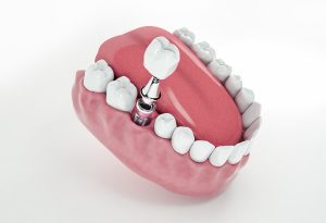 protesis dentales sobre implantes dentales